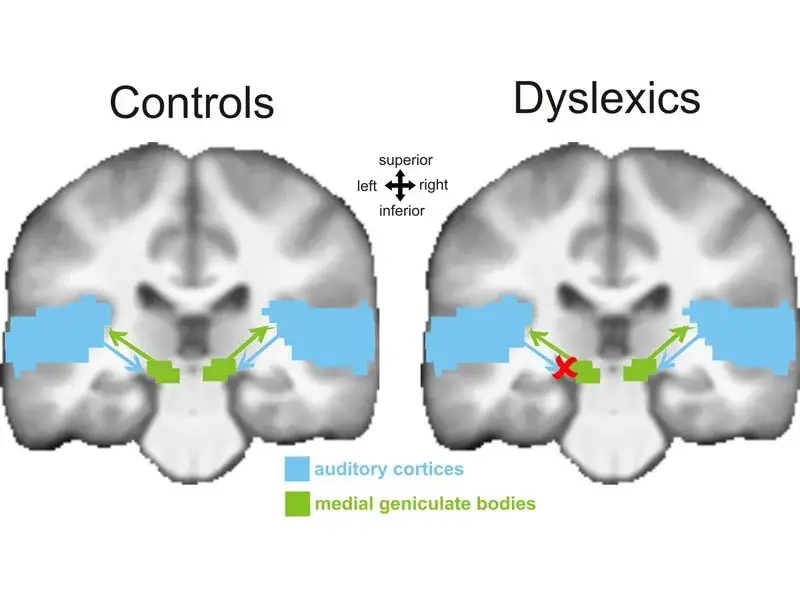 mózg dyslektyka schemat